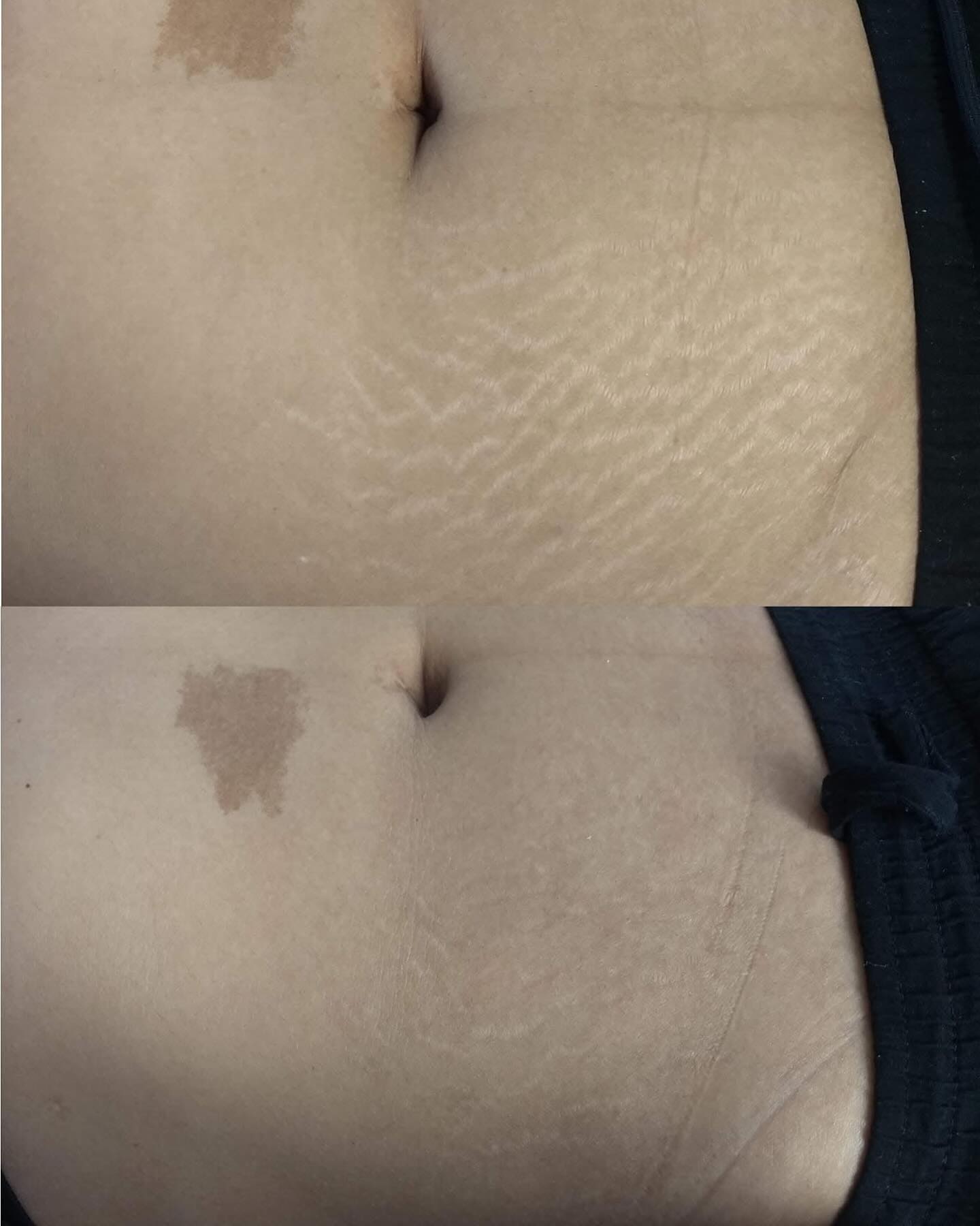 Antes e depois de procedimento de Microderme realizado por Duda Paiva